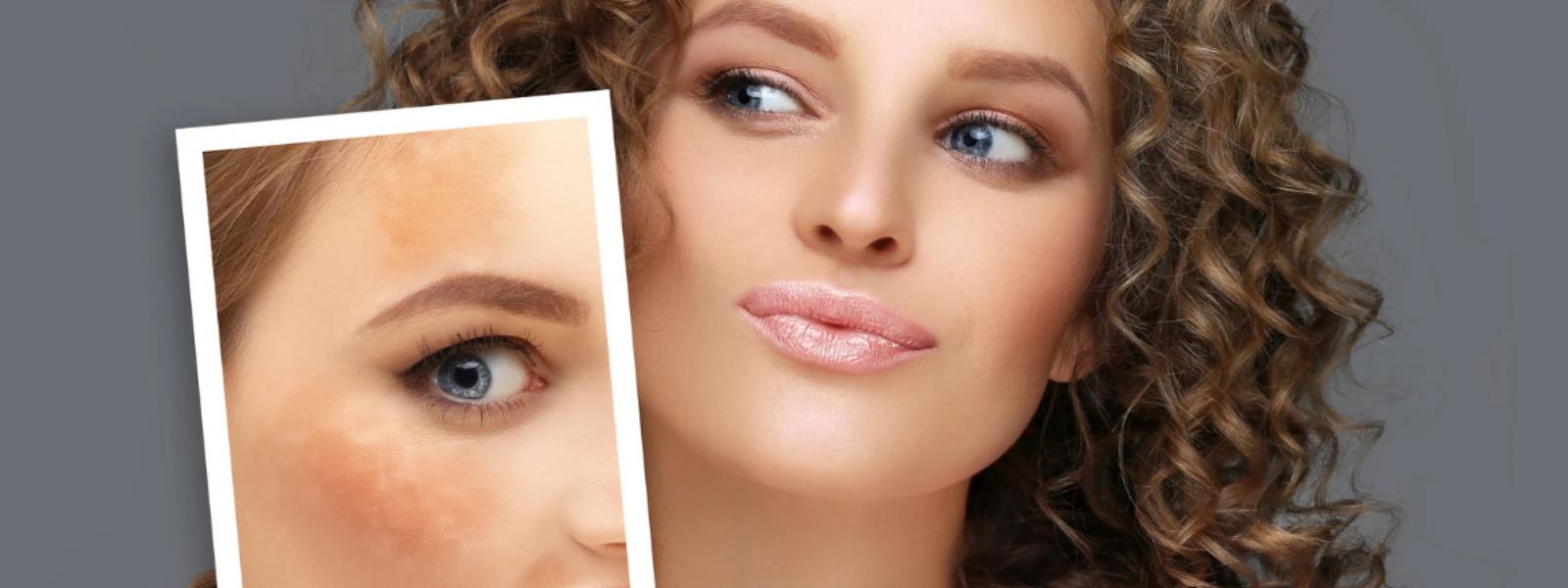 Melasma Skincare Routine FAQ: Your Guide to Fading Dark Spots