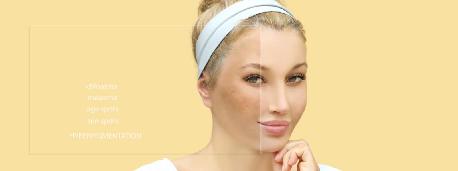 Pigmentation Removal FAQ: Your Guide to Clearer Skin