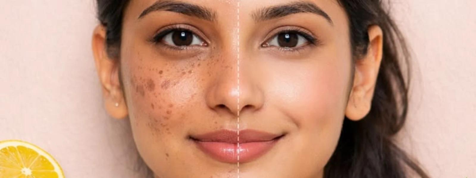 PIH Treatment Options FAQ: Your Guide to Hyperpigmentation