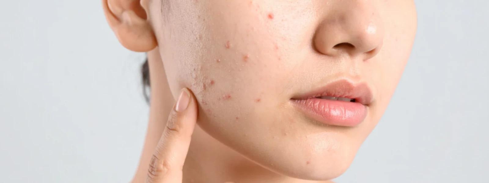 Post-Acne Marks Treatment: A Step-by-Step Guide for Clearer Skin