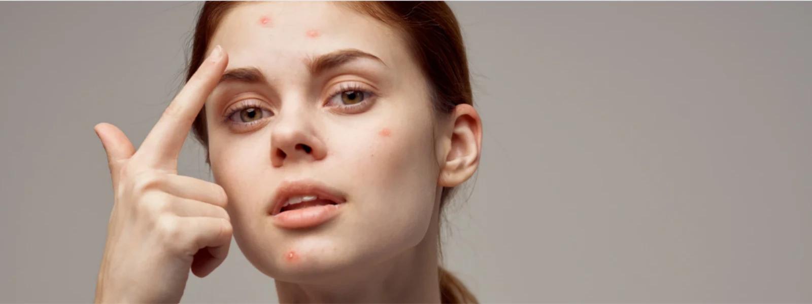Salicylic Acid for Acne FAQ: Your Questions Answered