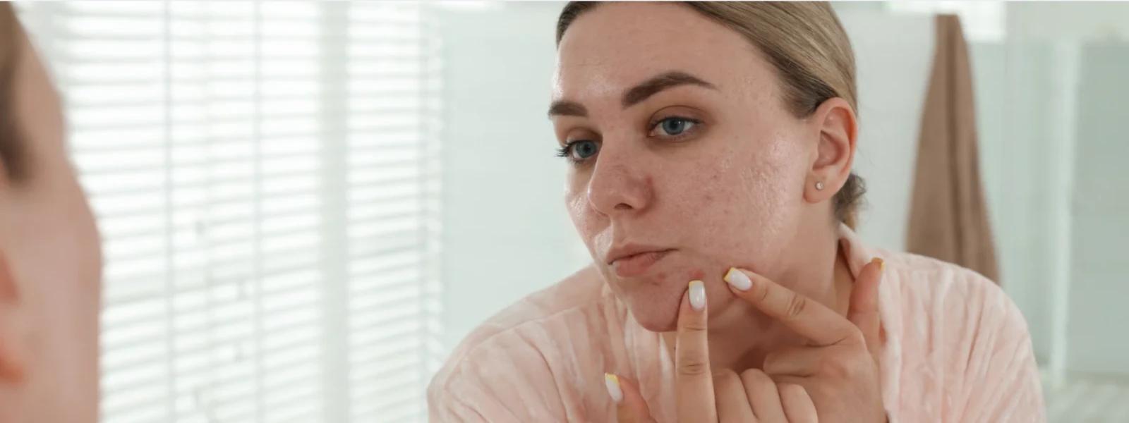 Step-by-Step Guide to Skin Fading Treatment Options for Hyperpigmentation