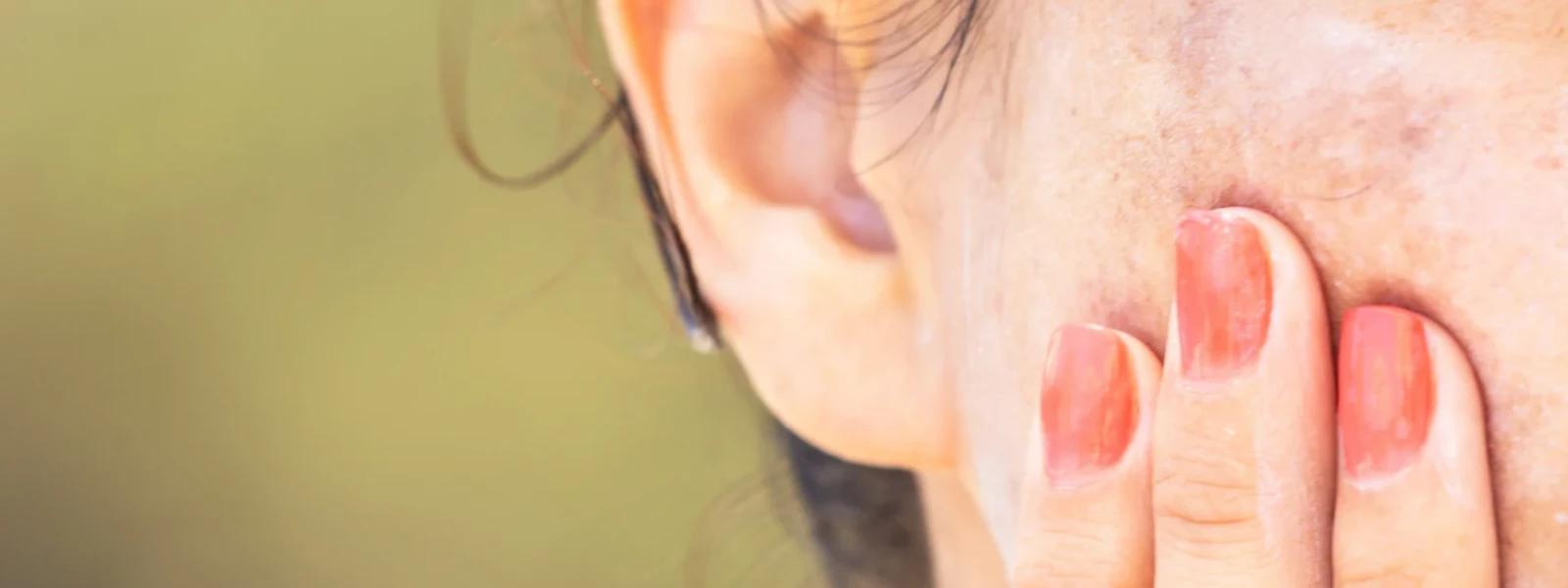 The Ultimate Checklist: How to Get Rid of Hormonal Acne for Good