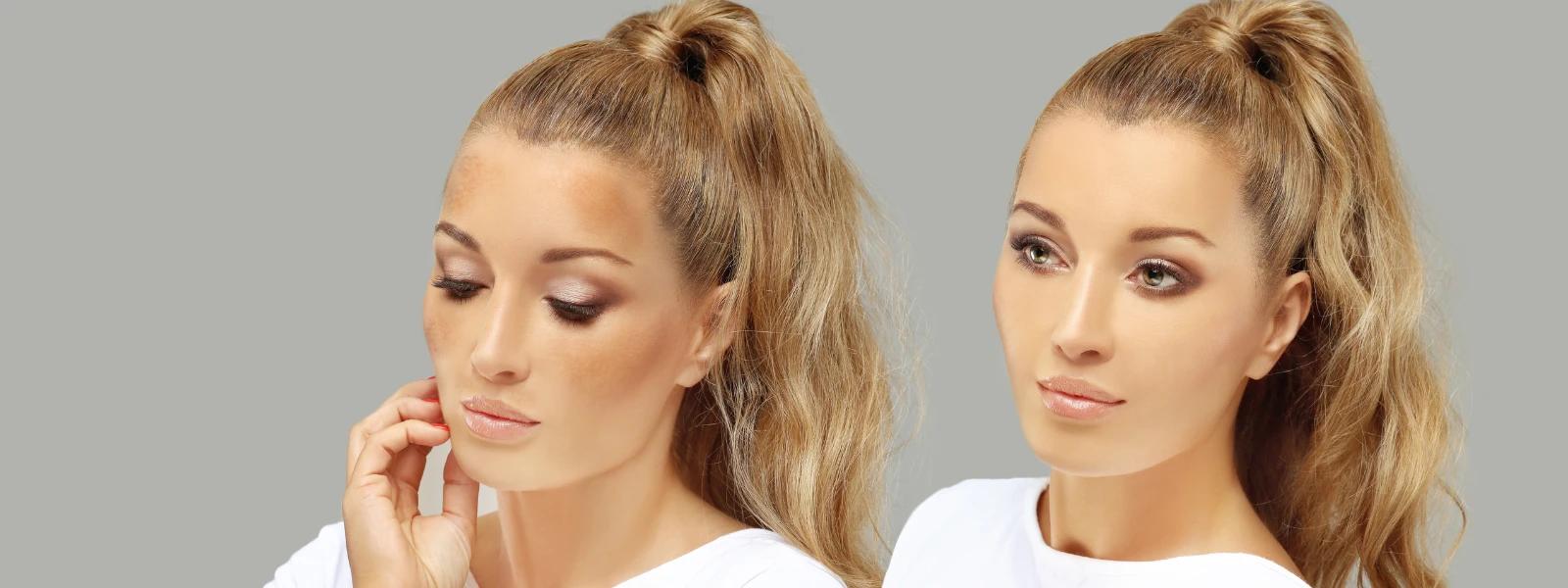 What Causes Melasma? Understanding Hyperpigmentation Causes