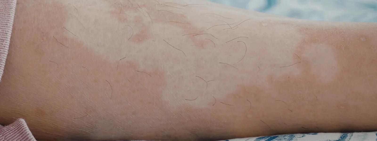 What Causes Skin Spots? Your FAQ Answered
